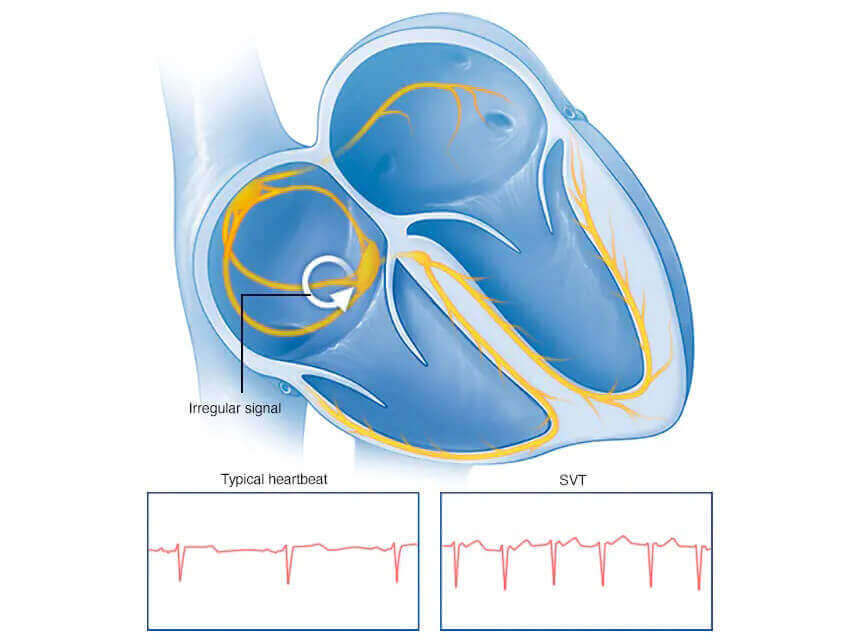 Supraventricular Tachycardia Treatment